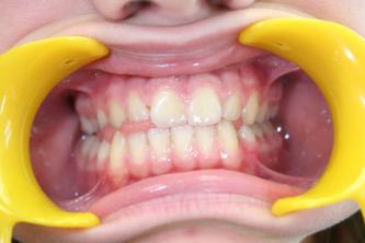 orthodontiste posture Caen orthodontiste posture Caen