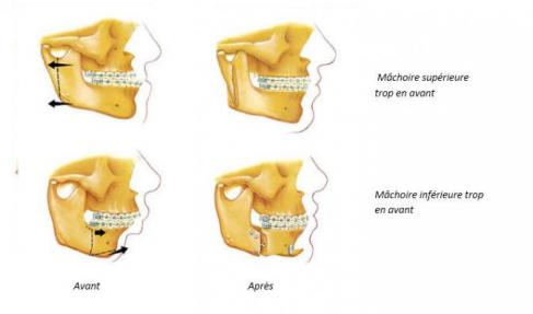mâchoire supérieur et inférieur schéma 