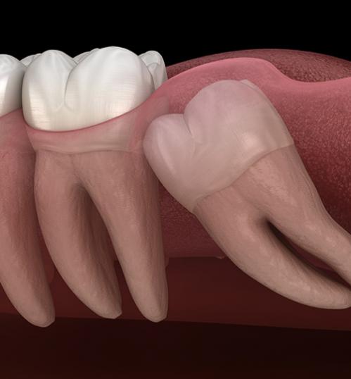 dents de sagesse