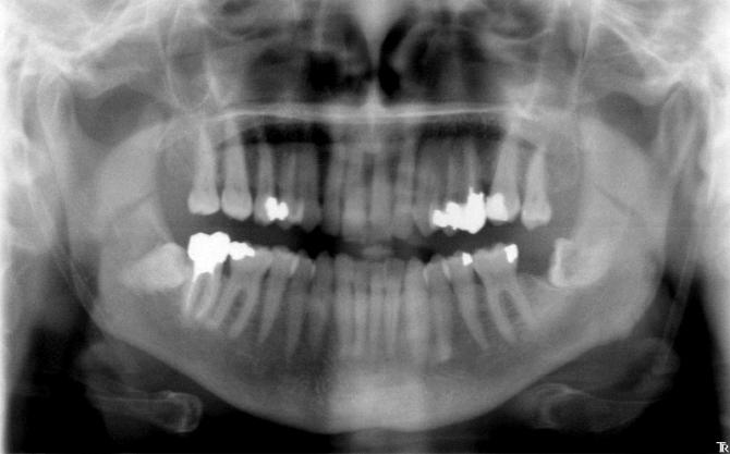 Dents de sagesses inférieures incluses horizontales Dents de sagesses inférieures incluses horizontales